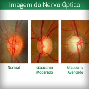 3-imagem-do-nevo-optico-colocar-em-glaucoma-e-em-estereofoto-de-papila